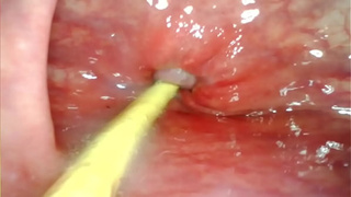 EXTREME ANAL POINT OF VIEW. ONLINE CAMERA INSIDE HER BUTTHOLE AS I POUND HER WITH MY GIGANTIC DONG AND JIZZ DEEP INSIDE